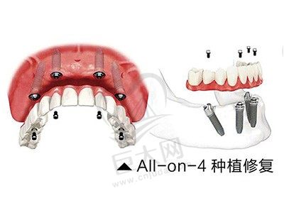 60岁半口牙缺失患者,找深圳正夫口腔林常陛all-on-4种植牙案例