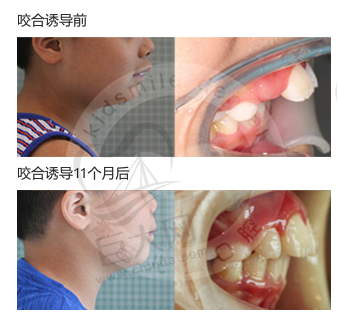 儿童牙齿功能矫正器那种好？看罗慕咬合诱导11个月效果图