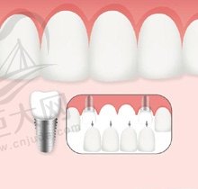 上海鼎植永博口腔种植牙怎么样?价格贵不?想看下种植牙案例