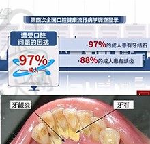 牙结石可以自己抠掉吗，洗牙会对牙齿造成伤害吗？