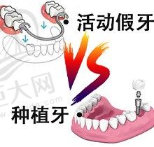 揭秘！种植牙和活动假牙哪个后遗症比较多？能和真牙一样吗？