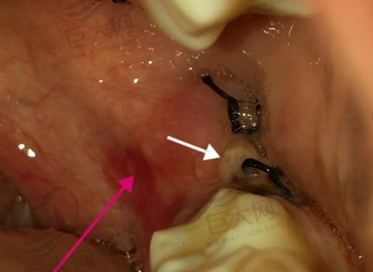 拔智齿洞恢复过程14天图解，看看拔智齿后牙洞多久能长好！