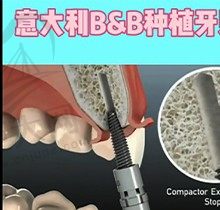 剖析：意大利bb种植牙怎么样？和瑞士iti相比哪个好/性价比更高？