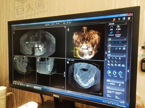 北京劲松口腔国贸分院种植牙