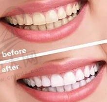 牙医建议不要做冷光美白，难道是冷光美白对牙齿有伤害？