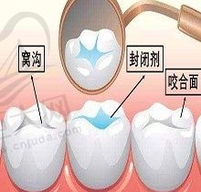 3岁孩子窝沟封闭有必要吗？闺蜜说不要做儿牙窝沟封闭我该信吗