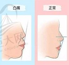 凸嘴千万不要戴牙套是真的吗？难道是因为戴牙套会越来越凸吗