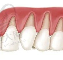 找到了正常牙齿和牙龈萎缩对比图，解释下牙龈萎缩能长出来吗