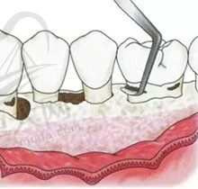 来看牙周翻瓣手术的流程，顺便解答牙周炎翻瓣手术一定要做吗