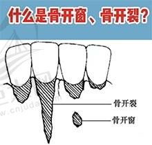 正畸过程骨开窗开裂了怎么办？怎么处理治疗牙医在线解答