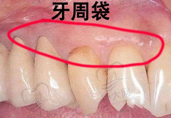 有牙周炎的牙周袋图片是啥样，牙周袋三个类型分类怎么判断呢