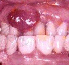 牙龈癌和牙龈炎症状区别照片：教你牙龈癌的早期鉴别诊断技巧