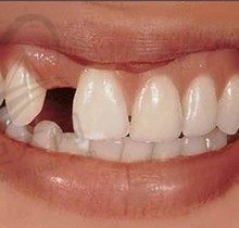 大牙间隔6毫米不影响种植吗？缺失牙间隙太小怎么处理能种牙吗