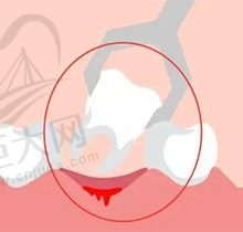 医生称孩子换牙期自行拔牙不可取，来解答孩子换牙该不该拔牙