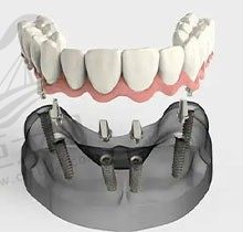 全口种植牙有几种方式？有缺牙患者询问种植牙种八颗多少钱