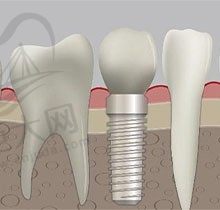 种植牙韩国的和国产的哪个好？那就从价格/材质/寿命来揭晓