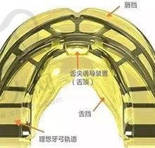 儿童牙齿矫正器有必要用吗? 听说戴矫治器有副作用是真的吗