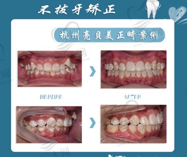 杭州亮贝美口腔医院不拔牙矫正“龅牙”,金属牙套正畸病例讲解!