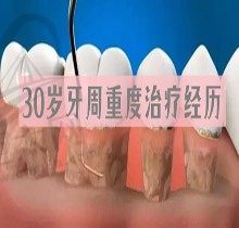 亲身讲述30岁牙周病可以治好吗？得了牙周病到底有必要治吗
