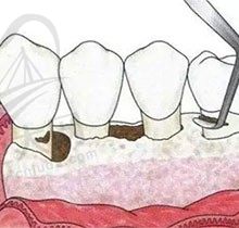 牙周翻瓣手术的流程包括什么？牙周翻瓣手术总共费用是多少啊