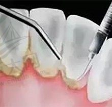 牙周刮治能治好牙周炎吗？做了牙周刮治有啥要注意的