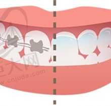 牙齿矫正戴牙套会牙龈萎缩吗?初次整牙没有啥需要注意的？
