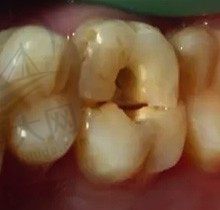 热牙胶根管治疗和普通根管治疗哪个好？揭晓两者间区别
