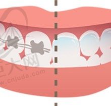 有人说门牙外凸不建议再矫正了？正畸医生告诉你正确矫正方法