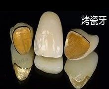 烤瓷牙套里面牙烂光了怎么办？请问烤瓷牙能用多少年啊