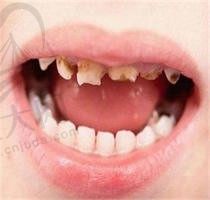 9岁小孩门牙摔断了还能长出来吗？牙磕掉一半有啥修复方法吗