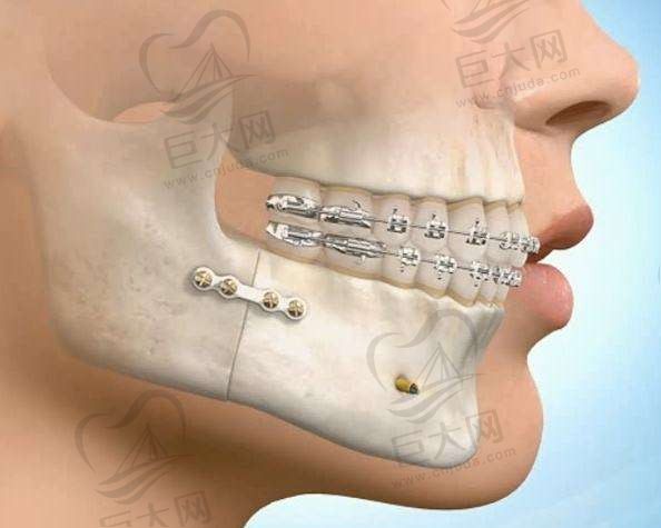 骨性凸嘴必须做正颌手术吗？谁有骨性凸嘴正颌手术后脸型改变图