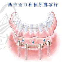 西宁全口种植牙哪家好？了解西宁种一口好牙的价格看这里