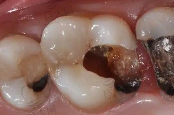 牙烂到什么程度要根管治疗？什么情况下必须做根管治疗？