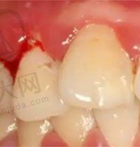 为啥牙周治疗后牙龈还是红肿？有人说治疗牙周炎后牙龈更疼了