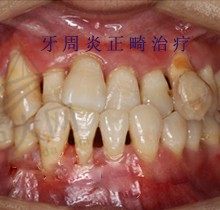 牙周炎医生不建议整牙真的吗？有没有牙周炎正畸成功病例参考