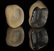 修复牙齿全瓷牙冠与牙齿贴面首选哪种?看什么情况下做牙冠？