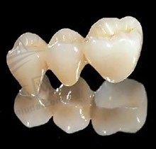 为什么掉一颗牙就要镶两三个？镶的牙一般可以用多久呢？