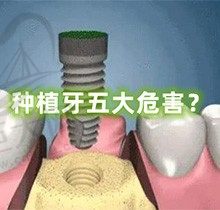分享种植牙的五大危害，听说这5种人不宜种植牙你知道吗？