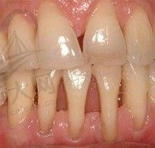 牙龈萎缩牙根外露怎么治疗？求问牙龈再生术有人做过吗效果怎样