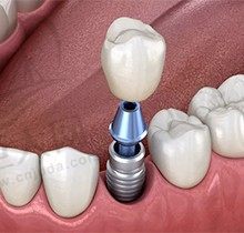 种植牙哪个步骤更痛苦？图解种植牙过程对比和烤瓷牙哪个更好点