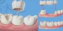 做牙冠把我牙齿害惨了，为什么医生更建议做牙冠而非拔牙