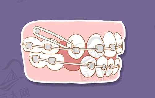 儿童反颌矫正器哪种比较好？孩子有点地包天愁死人了