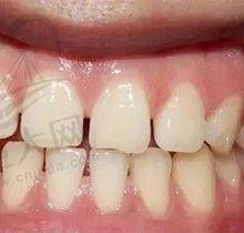 牙齿缝隙越来越大是怎么回事？缝隙发黑怎么修复呢需要多少钱