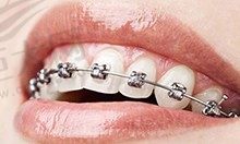 做牙齿矫正能洗牙吗？想了解一下矫正期间如何清洁牙齿