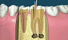 做了根管治疗后不能矫正牙齿？想问问根管治疗有什么危害？