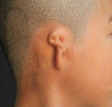 北京八大处小耳畸形手术全部费用是多少？耳再造看准这几位医生技术好