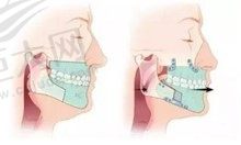 正颌手术有必要做吗？为什么医生通常不建议做正颌手术？