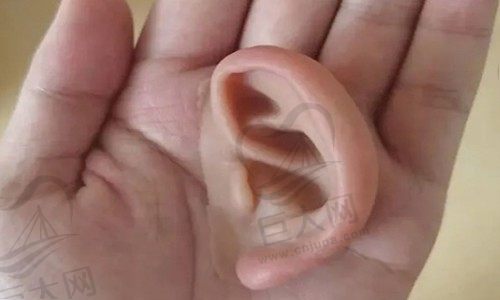 没有耳朵怎么做假耳朵?听听医生怎么说义耳和外耳再造哪个好