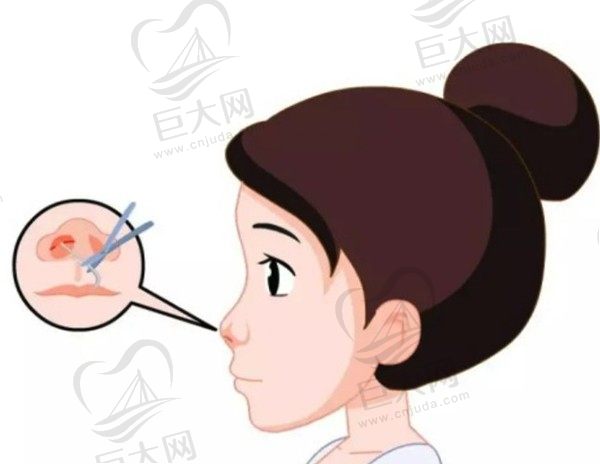 膨体隆鼻和硅胶隆鼻哪个更好？看隆鼻膨体和硅胶优缺点就明白了