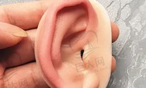 畸形耳朵无家族史会遗传吗？想知道耳朵畸形多少岁可以做？